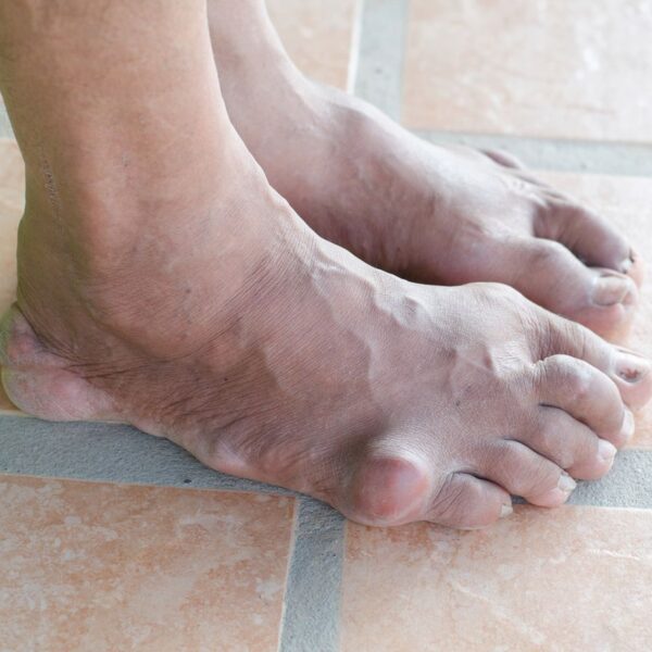 Jak rozpoznać i skutecznie leczyć dnę moczanową?