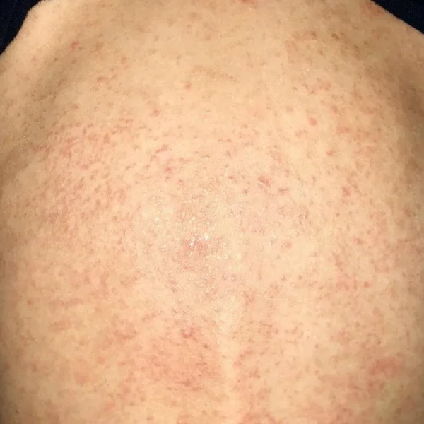 Jakie są objawy aids i jak skutecznie z nim żyć?