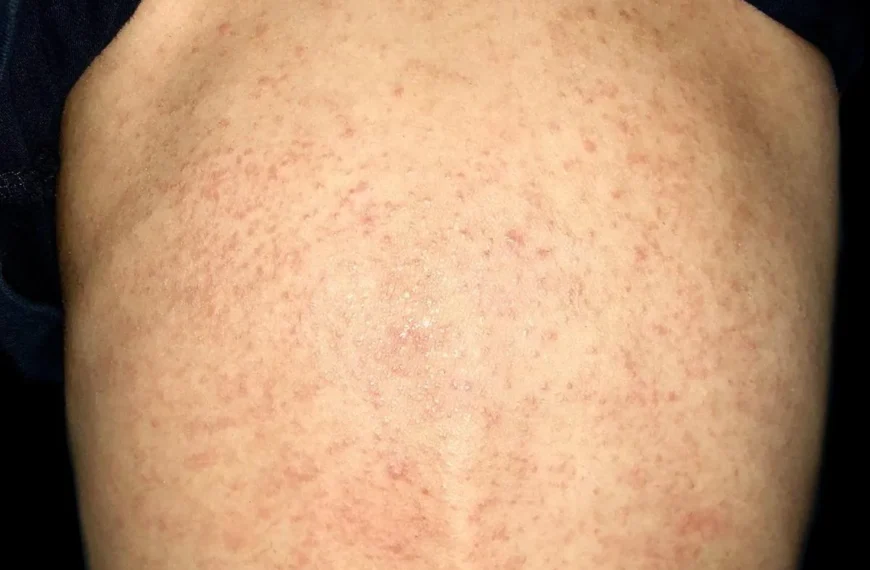 Jakie są objawy aids i jak skutecznie z nim żyć?