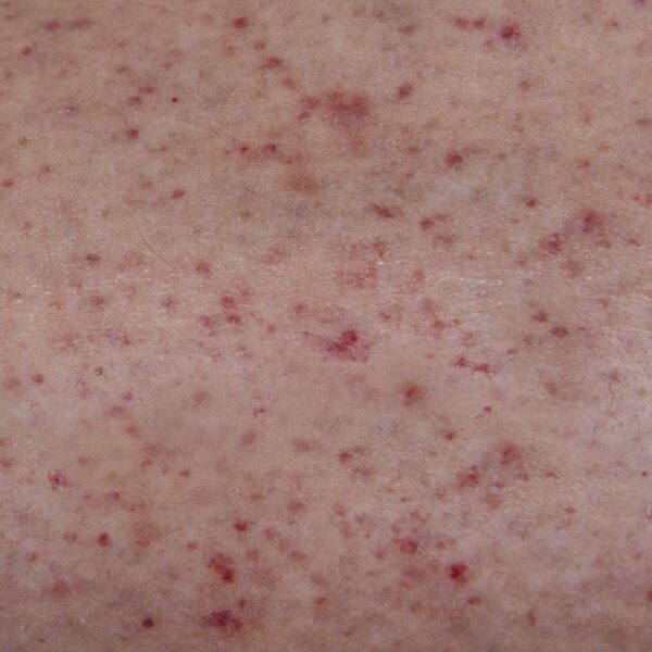 Sepsa – jak rozpoznać objawy i skutecznie reagować?