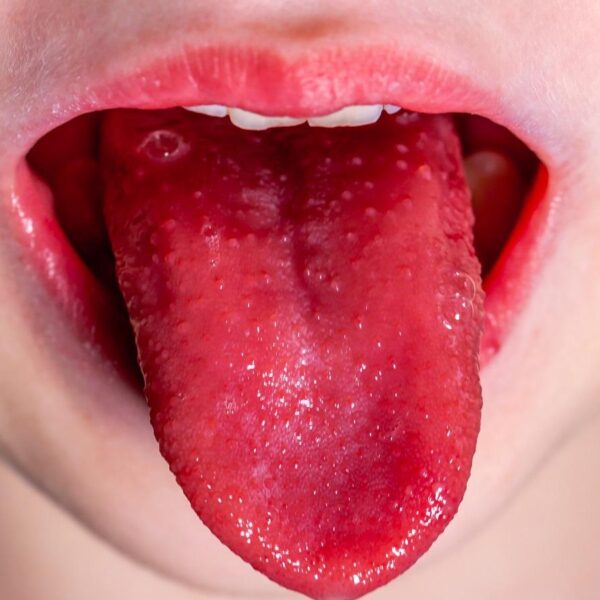 Szkarlatyna u dorosłych – objawy, leczenie i zagrożenia, których nie można lekceważyć